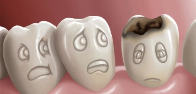 Χαλασμένα δόντια; Ποιους κινδύνους κρύβουν για την υγεία