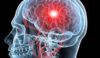 Ανεύρυσμα στον εγκέφαλο: Tα συμπτώματα