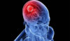 Όγκος στο κεφάλι: Προσοχή σε συμπτώματα, αίτια και παράγοντες κινδύνου