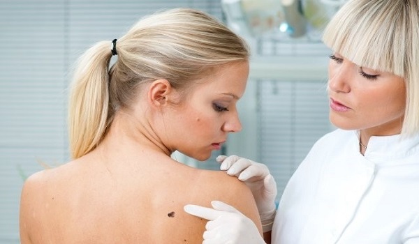 Καρκίνος δέρματος: Τα 6 βήματα για σωστή αυτοεξέταση