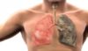 Καρκίνος του πνεύμονα: Πώς μπορεί να συμβεί σε όσους δεν καπνίζουν