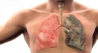 Καρκίνος του πνεύμονα: Πώς μπορεί να συμβεί σε όσους δεν καπνίζουν