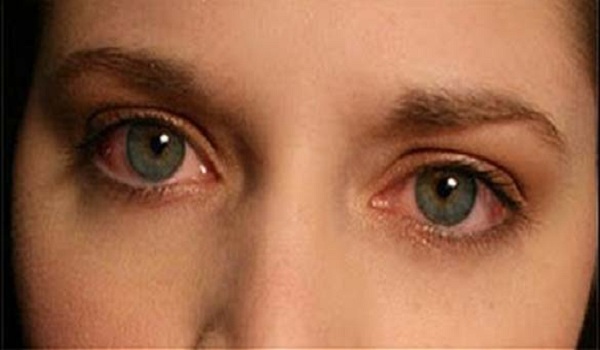 Ποια σημάδια στα μάτια σας αποκαλύπτουν την αύξηση της χοληστερίνης σας;