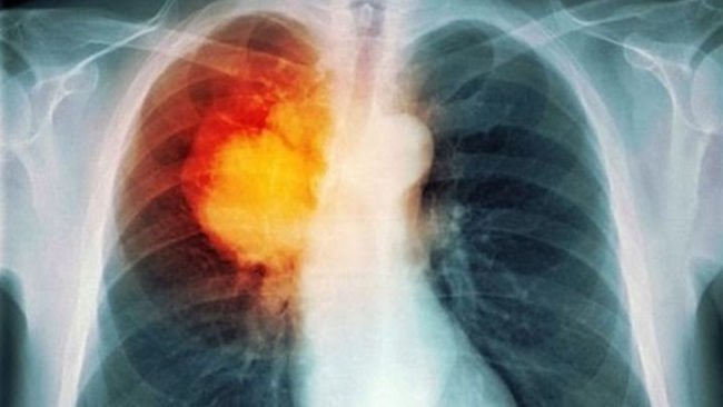 Εγκρίθηκε νέα θεραπεία για τον καρκίνο πνεύμονα