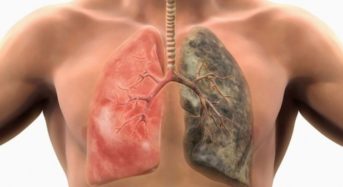 Καρκίνος του πνεύμονα -Πότε εμφανίζονται τα πρώτα συμπτώματα
