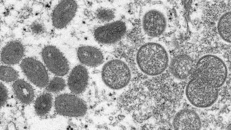 Τι γνωρίζουμε για τον ιό της ευλογιάς των πιθήκων